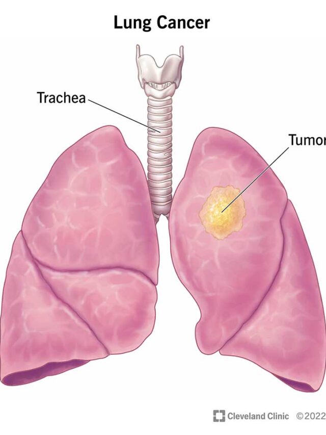 What is Lungs Cancer