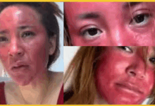 influencer-face-damaged-after-22-years-of-continuous-makeup