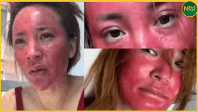 influencer-face-damaged-after-22-years-of-continuous-makeup
