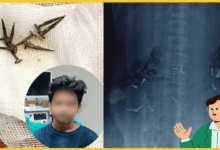gorakhpur-boy-swallows-nails-after-scolding-rescued-by-colonoscopy
