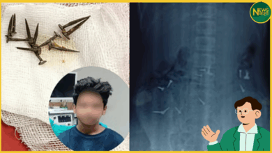 gorakhpur-boy-swallows-nails-after-scolding-rescued-by-colonoscopy
