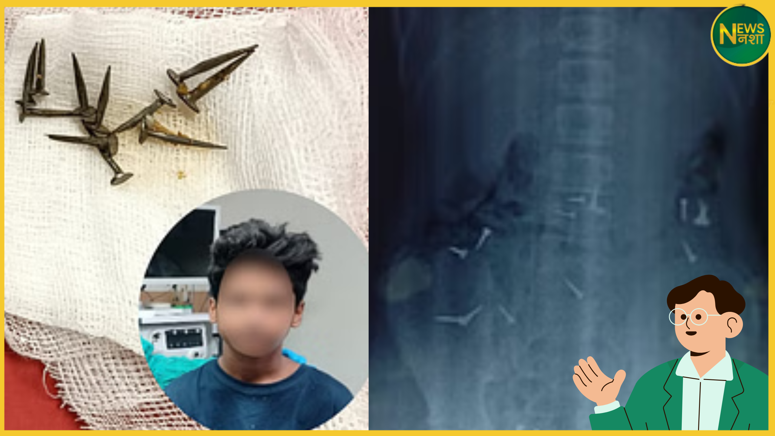 gorakhpur-boy-swallows-nails-after-scolding-rescued-by-colonoscopy