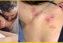 hickey-love-bite-dangerous-side-effects-stroke-risk-health-tips
