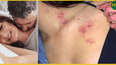 hickey-love-bite-dangerous-side-effects-stroke-risk-health-tips