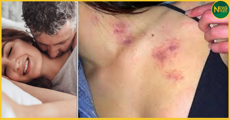 hickey-love-bite-dangerous-side-effects-stroke-risk-health-tips